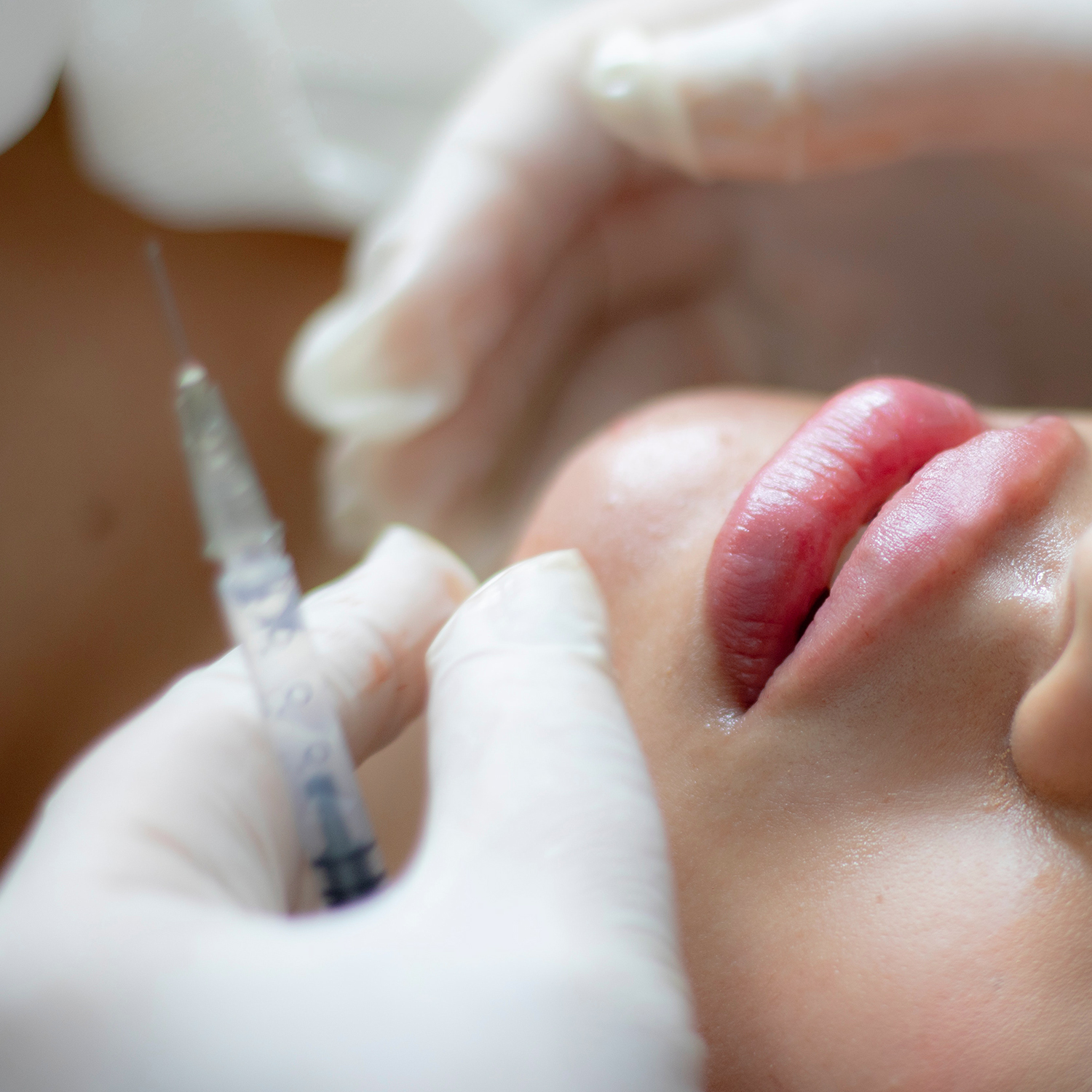 Dermal Filler Services in Lake Mary